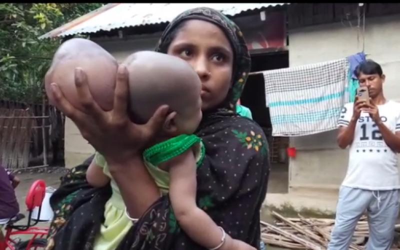বিলাসীপাৰাৰ শালটাৰী গাঁৱৰ শাৰীৰিকভাৱে ব্যতিক্ৰম এটি শিশুক লৈ কৌতুহল